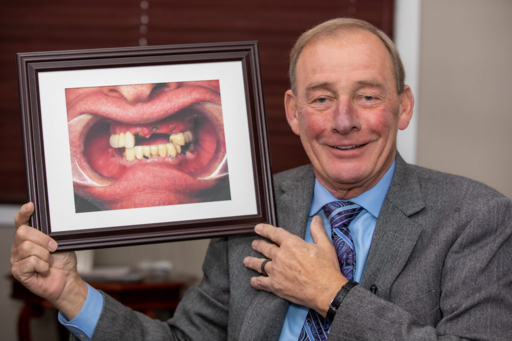 Full Mouth Dental Implants Grace Dental Framingham, MA