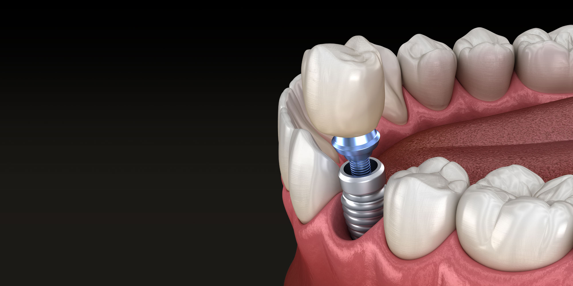 implantes dentales en houston
