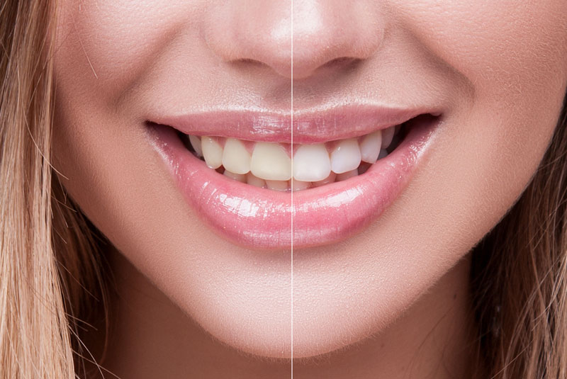 teeth whitening before and after