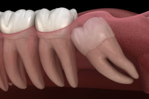 Impacted Wisdom Tooth