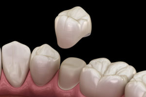Dental Crown Model