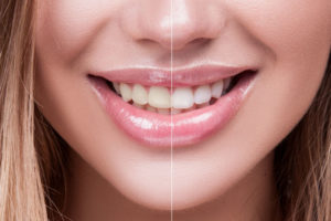 Tooth Whitening Patient Before and After