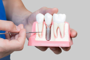 Dental Assistant Showing Off A Dental Implant In A Jawbone Cutaway Model in Framingham, MA