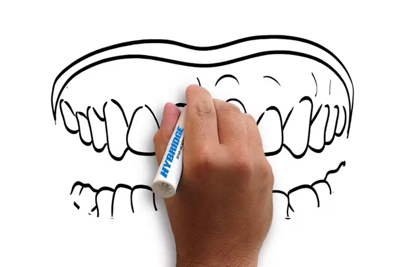 hybridge dental implant video