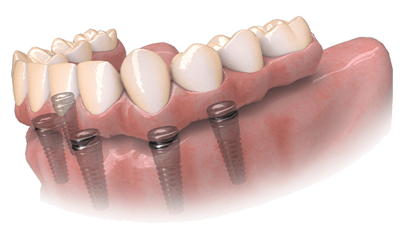 hybridge dental implants