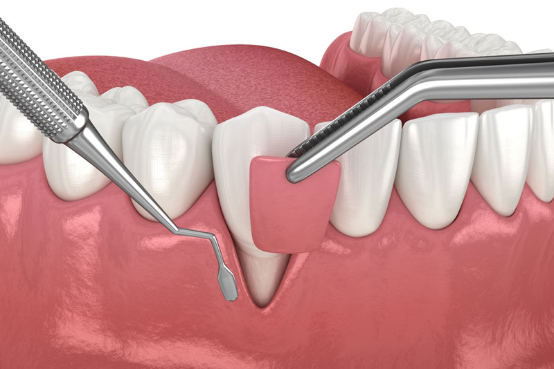 Illustration of gum graft surgery procedure to treat receding gums, showing tissue placement and dental instruments in use.