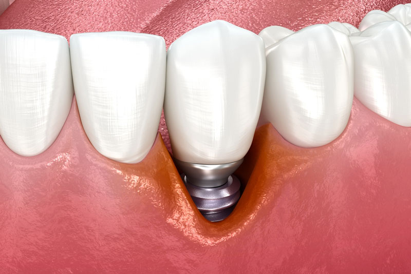 Close-up of peri-implantitis showing gum recession around a dental implant, revealing exposed implant threads and tissue inflammation.